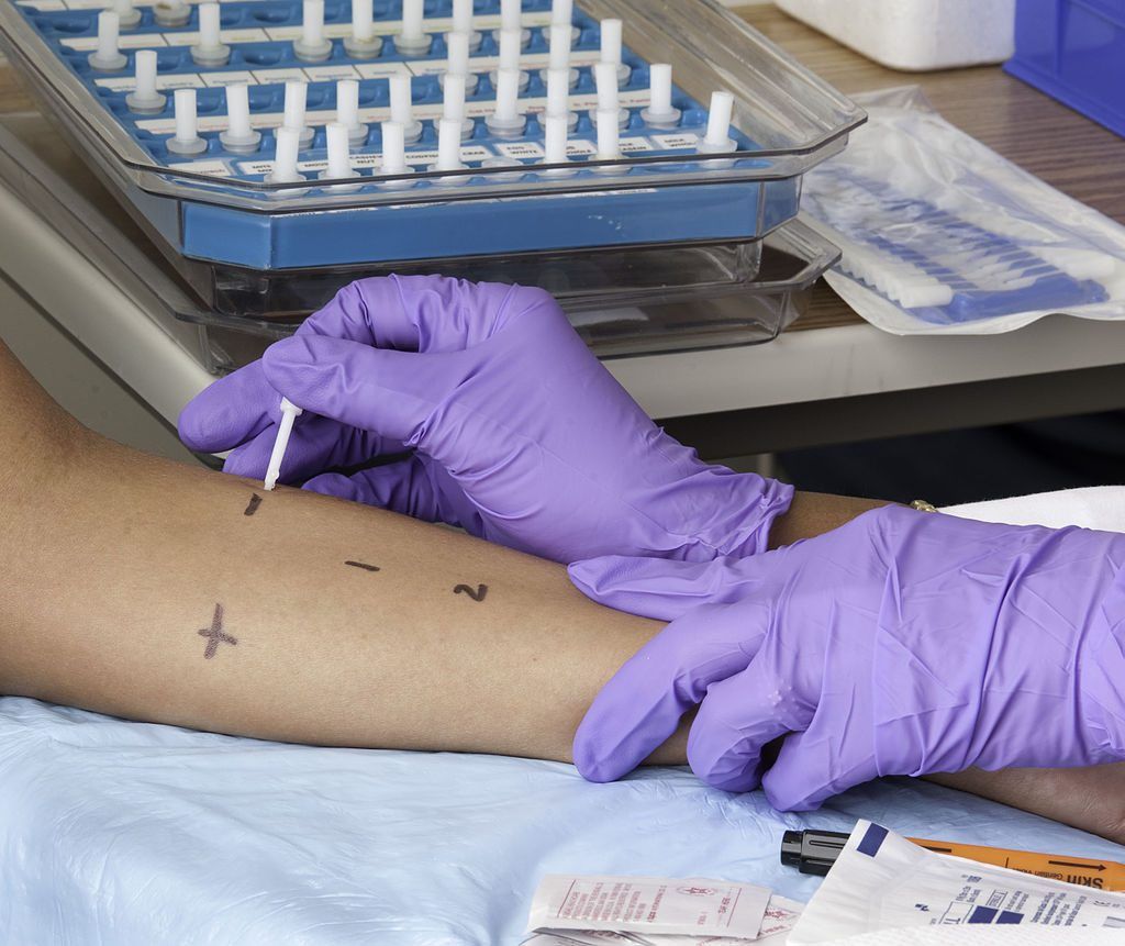 prick test